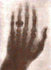 earliest photographic plates from Roentgen's experiments of Bertha's hand