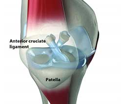 knee repair photo showing anterior cruciate ligament